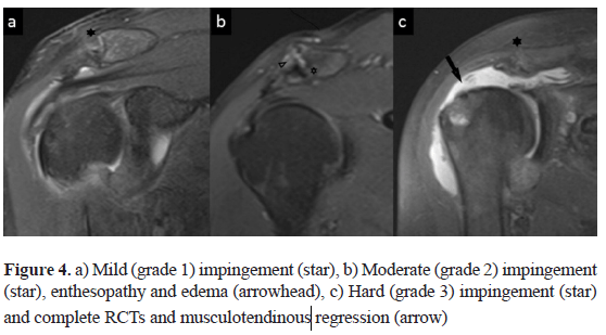 acromion types mri